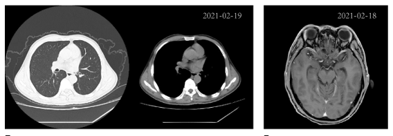 肺癌患者肺癌CT及MRI检测结果