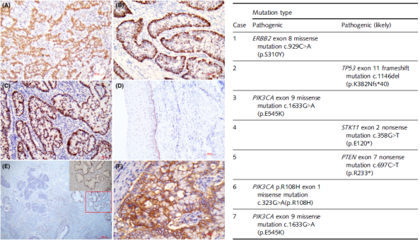 ISMC患者的免疫组化结果（左）和主要致病突变（右）。