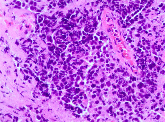 气管镜活检病理结果提示小细胞癌转化