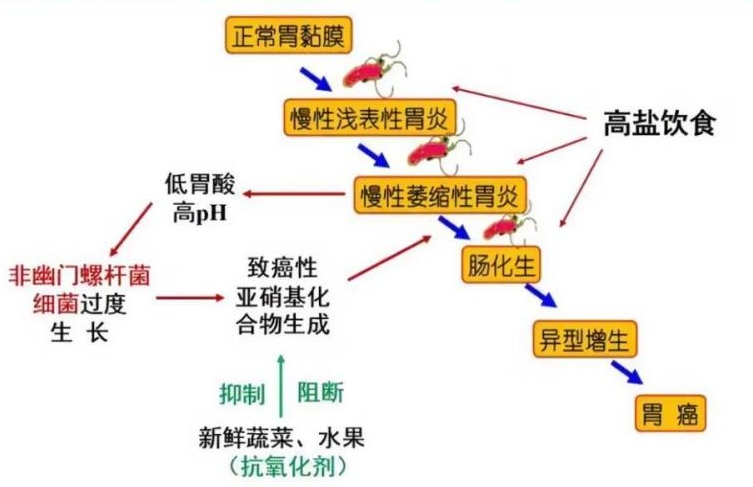 Correa教授提出的肠型胃癌发展模式