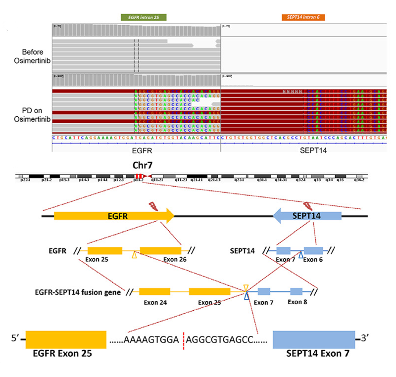 肿瘤患者EGFR-SEPT14融合突变亚型示例图