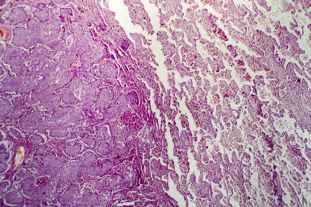 肺腺癌在光学显微镜下的照片