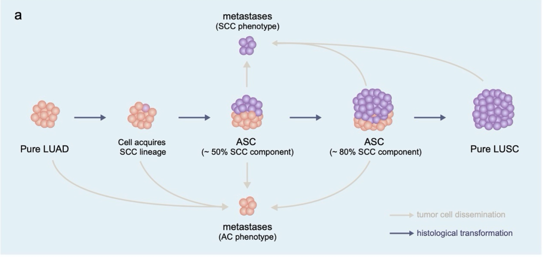 腺鳞癌可能是腺癌往鳞癌转化的中间态的设想