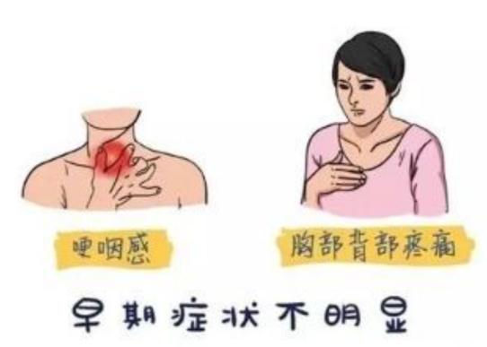食管癌早期症状