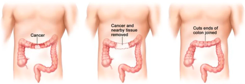 结直肠癌吻合术切除示意