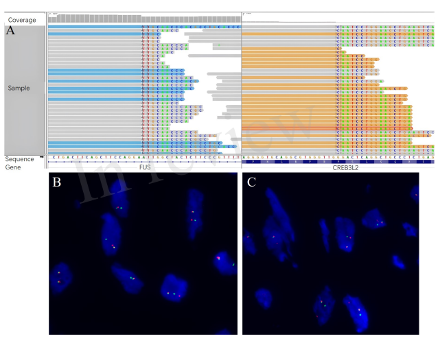 组织样本的NGS和FISH结果均显示存在FUS-CREB3L2
