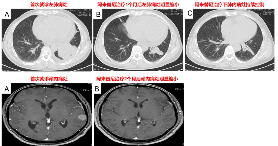 阿来替尼治疗后复查肺部及颅内病灶明显缩小