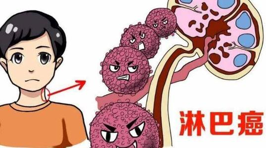 淋巴癌