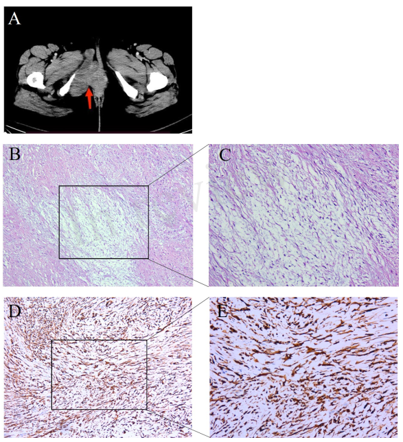 患者的CT影像和手术病理切片特征