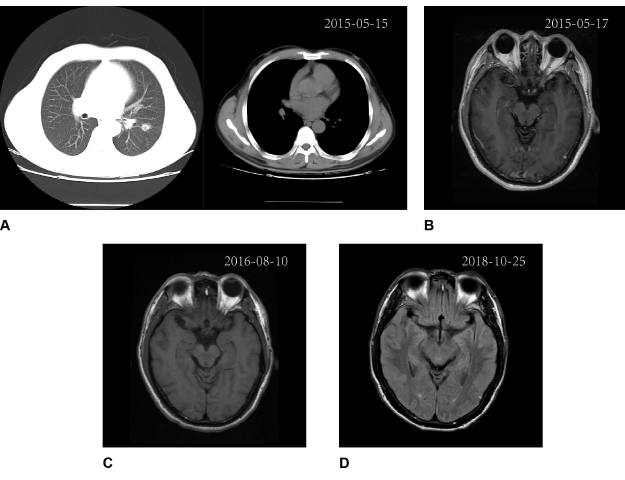 肿瘤患者诊疗期间影像学监测结果