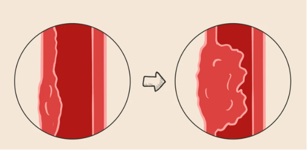 食管反复损伤自我修复引起炎症