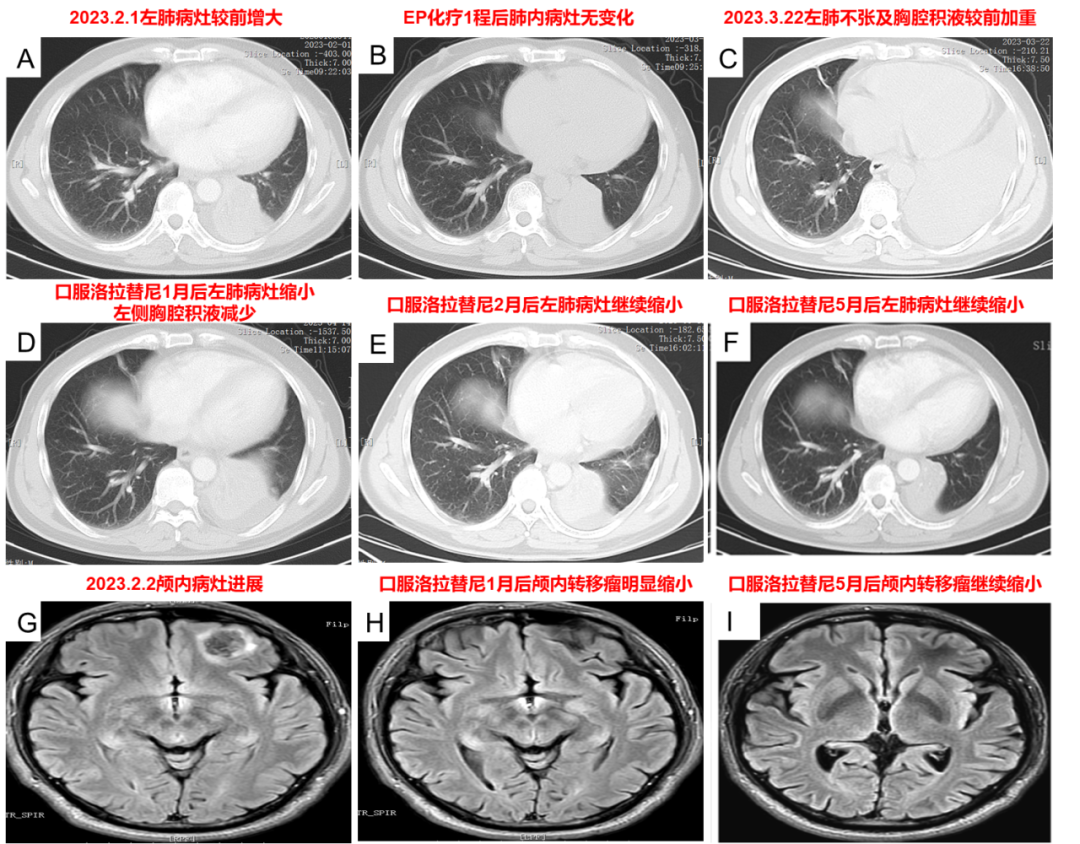 洛拉替尼治疗后复查肺部及颅内病灶明显缩小
