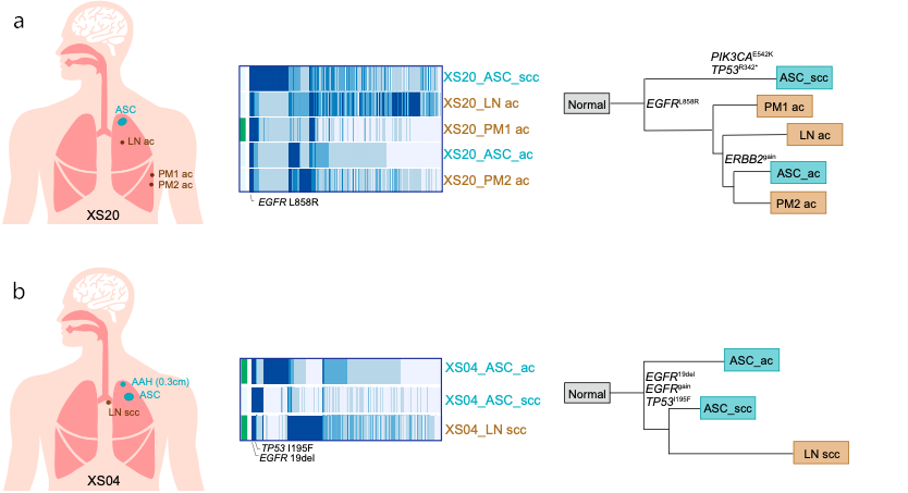 描述不同表型淋巴结转移和原发肺腺鳞癌成分之间关系的进化系统发生