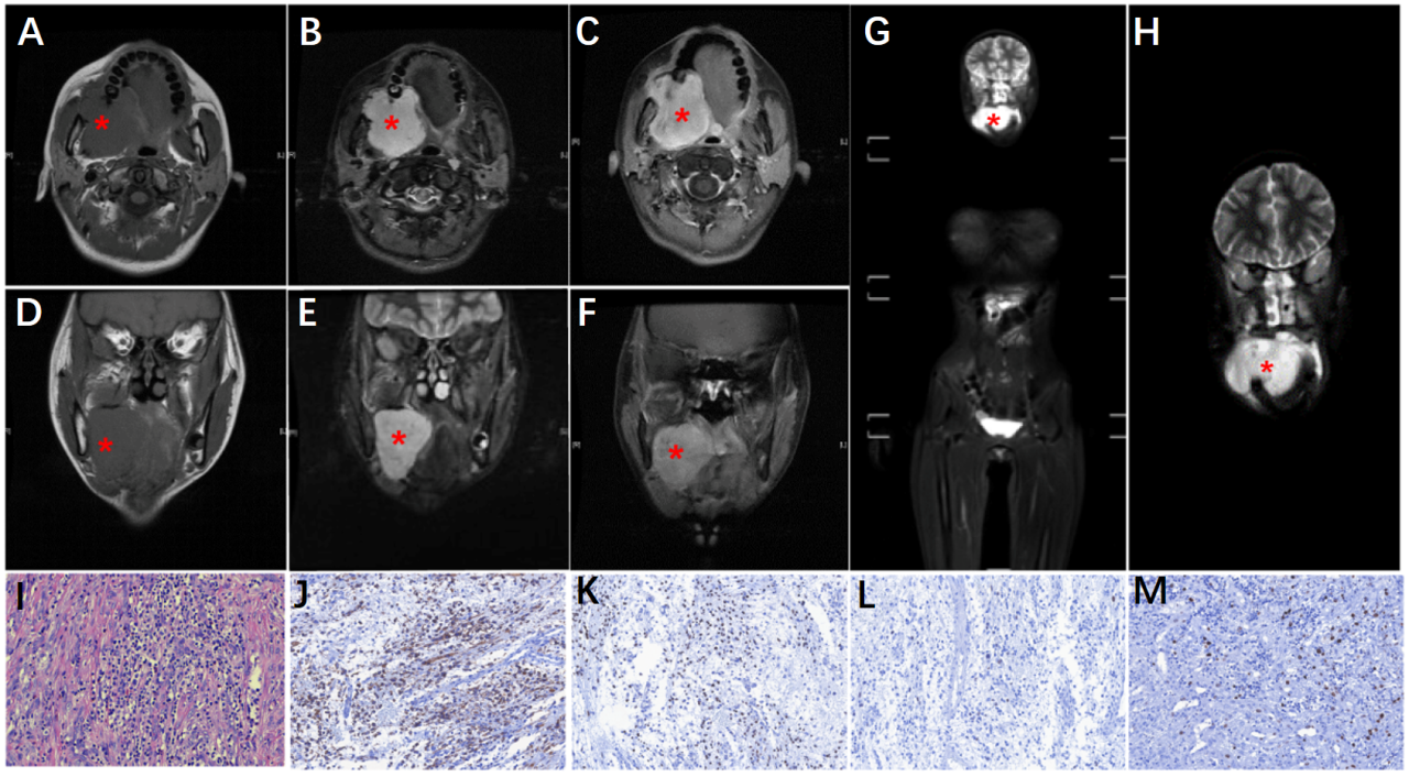 患儿影像学检查与组织病理学诊断