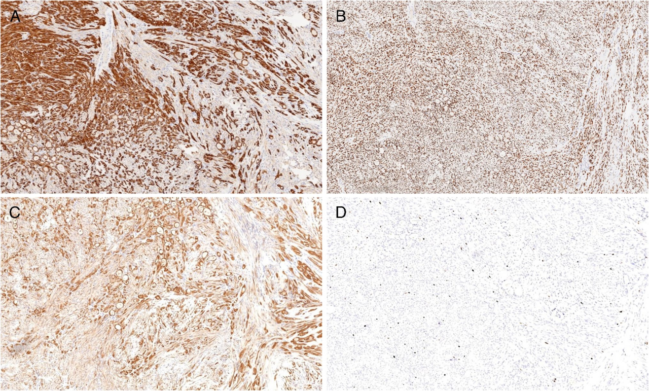 37000vip威尼斯基因肿瘤基因检测学术文章