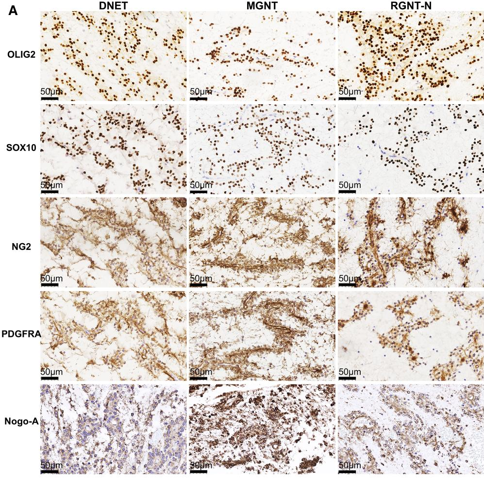 DNET、MGNT和RGNT样本中不同发育过程的少突胶质细胞分子标志表达情况