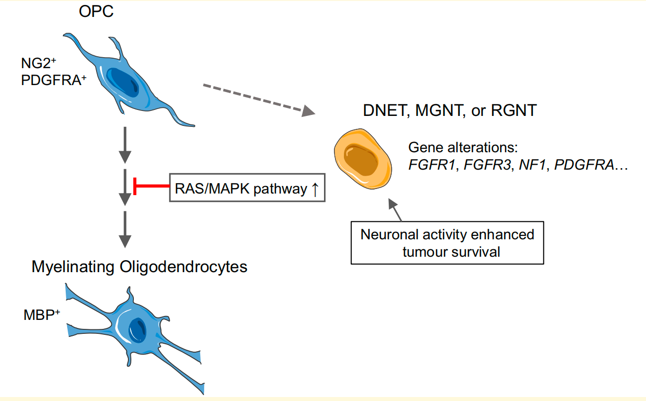 少突胶质前体细胞RAS/MAPK通路异常激活形成DNET、MGNT和RGNT肿瘤示意图