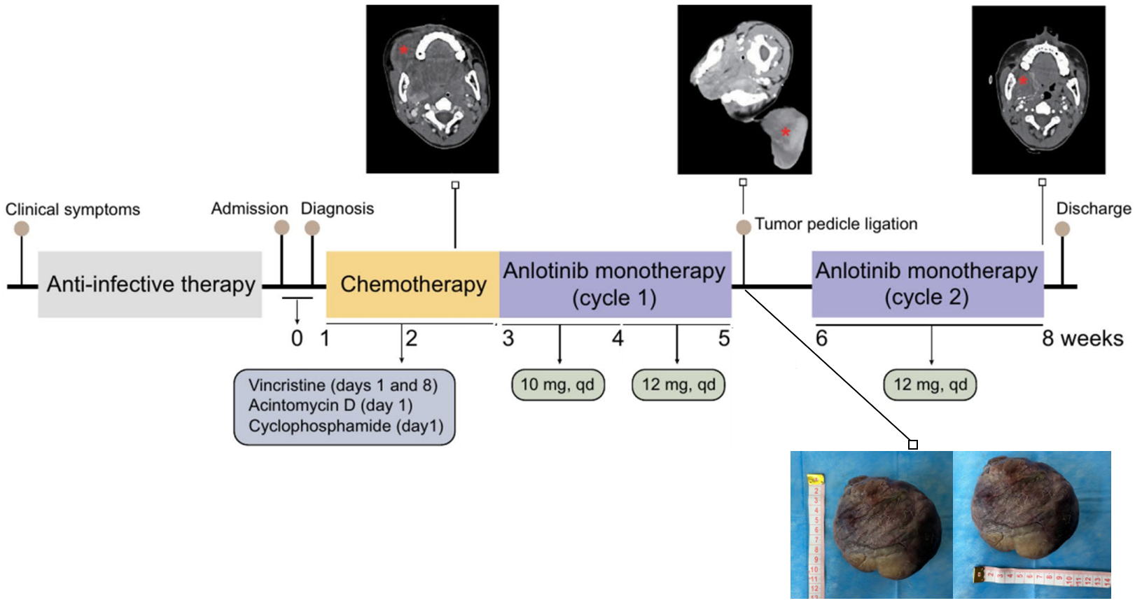儿童罕见胚胎横纹肌肉瘤的治疗过程及脱落肿块