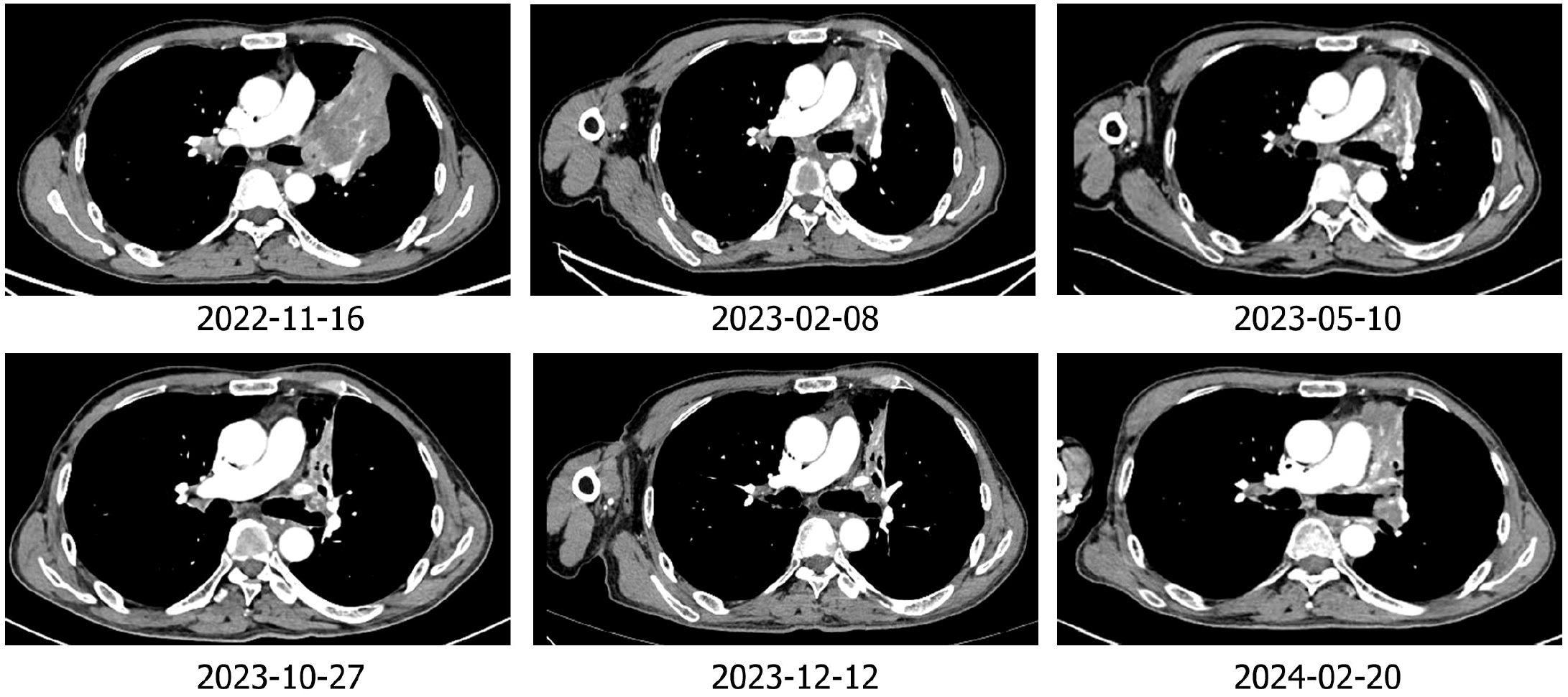 37000vip威尼斯一号&reg;大Panel助力肺大细胞神经内分泌癌靶免联合治疗获益
