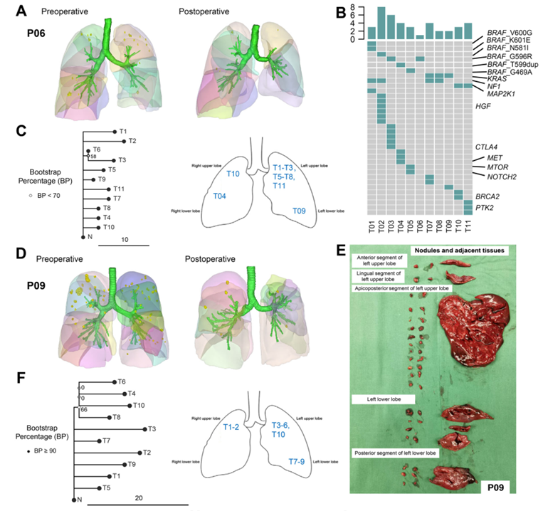 超级多原发肺癌的克隆进化举例